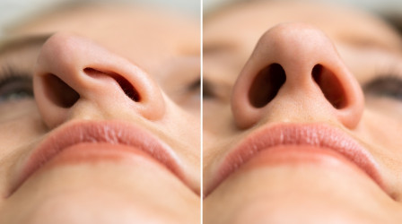 Septoplastika – priebeh, rekonvalescencia a riziká operácie nosovej priehradky