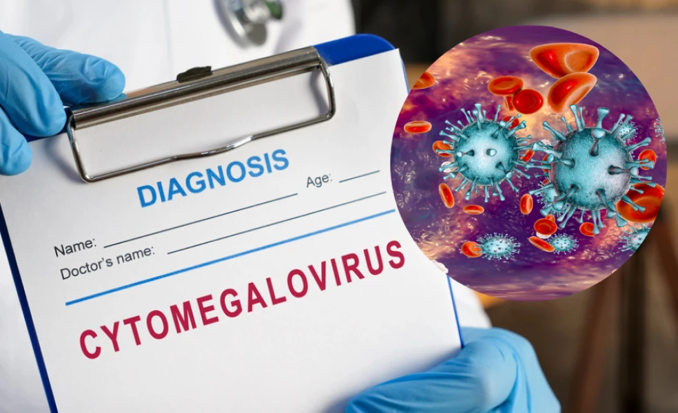 Cytomegalovírusová infekcia