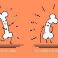 Aké sú rizikové faktory osteoporózy? Na toto treba dávať pozor!