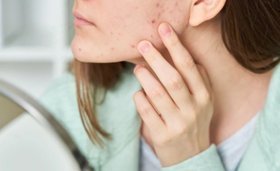 žena s aknóznou pleťou