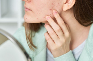 Ako vyliečiť aknóznu pleť?