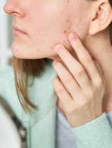 Ako vyliečiť aknóznu pleť?