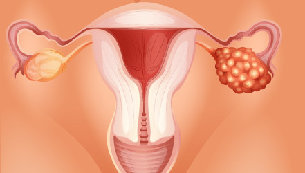Rakovina vaječníkov – spoznajte druhy nádorov, hlavné príznaky a možnosti prevencie