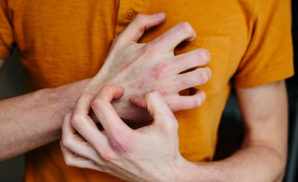 ako zlepšiť stav ekzému