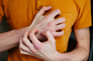 10 tipov, ako zlepšiť stav ekzému – jednoduché kroky pre zdravšiu pokožku