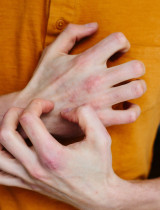 10 tipov, ako zlepšiť stav ekzému – jednoduché kroky pre zdravšiu pokožku