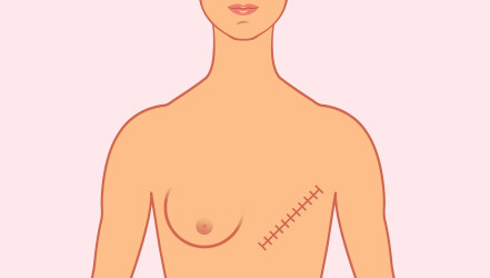 Odstránenie prsníkov alebo mastektómia – kedy ide o nevyhnutný zákrok a kedy sa robí aj preventívne?