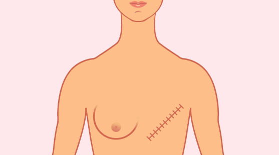 Odstránenie prsníkov alebo mastektómia – kedy ide o nevyhnutný zákrok a kedy sa robí aj preventívne?