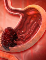 Čo zvyšuje riziko vzniku rakoviny žalúdka? Toto sú hlavné faktory!