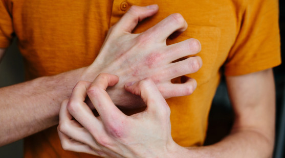 10 tipov, ako zlepšiť stav ekzému – jednoduché kroky pre zdravšiu pokožku