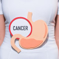 Rakovina žalúdka – aké sú príznaky, príčiny, spôsob diagnostiky a možnosti liečby?