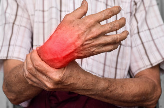 Artritída môže prepuknúť vo viacerých formách. Aké typy rozlišujeme a čo príznaky?