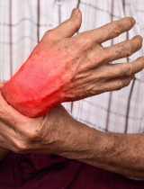 Artritída môže prepuknúť vo viacerých formách. Aké typy rozlišujeme a čo príznaky?