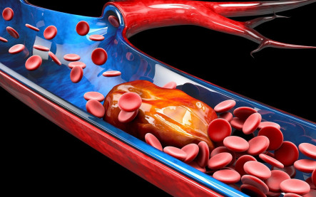 Hlboká žilová trombóza