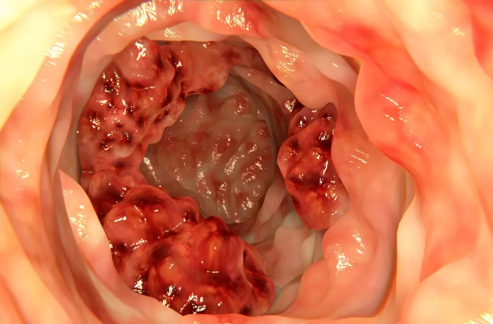 kolorektálny karcinóm