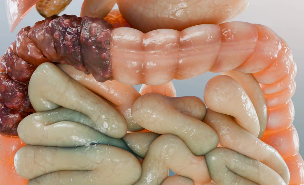 Skríning rakoviny hrubého čreva a konečníka