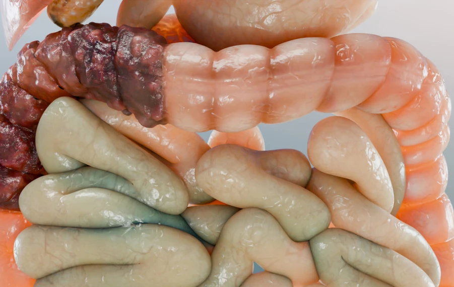 Skríning rakoviny hrubého čreva a konečníka