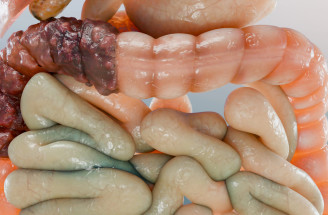 Skríning rakoviny hrubého čreva a konečníka: Pre koho je určený a aký má skutočný význam?