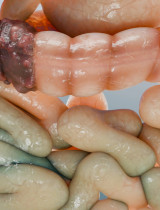 Skríning rakoviny hrubého čreva a konečníka: Pre koho je určený a aký má skutočný význam?