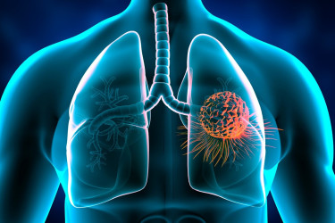 Čo zvyšuje riziko rakoviny pľúc? Je rizikovým faktorom len fajčenie?