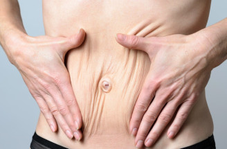 Diastáza brušných svalov nevzniká len u žien po pôrode. Aké sú možné príčiny a prejavy?