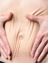 Diastáza brušných svalov nevzniká len u žien po pôrode. Aké sú možné príčiny a prejavy?