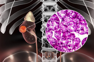 Rakovina obličiek: Dôležité informácie, ktoré môžu pomôcť zachrániť zdravie