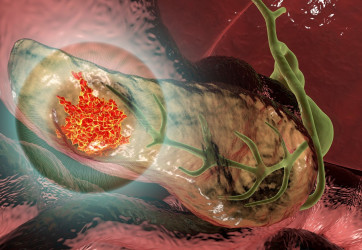 Aké sú rizikové faktory rakoviny pankreasu? Môžeme ich ovplyvniť?