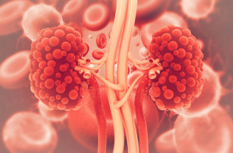 Cysty na obličkách: Kedy sú neškodné a kedy naopak spôsobujú ťažkosti?