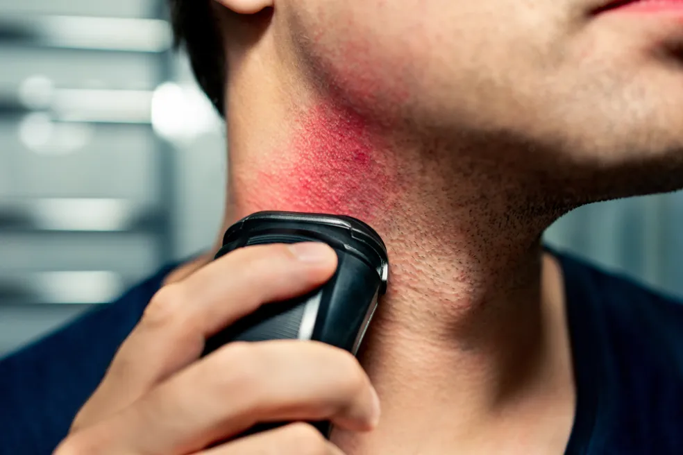 problémy po holení