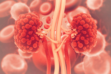 Cysty na obličkách: Kedy sú neškodné a kedy naopak spôsobujú ťažkosti?