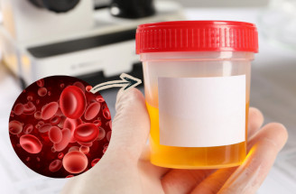 Pozor na hematúriu. Ako odhaliť krv v moči a aké sú možné príčiny?