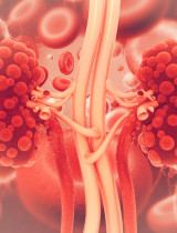 Cysty na obličkách: Kedy sú neškodné a kedy naopak spôsobujú ťažkosti?