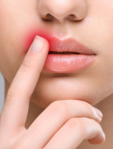 Herpes na pere: Aké sú jeho príčiny a následná liečba?