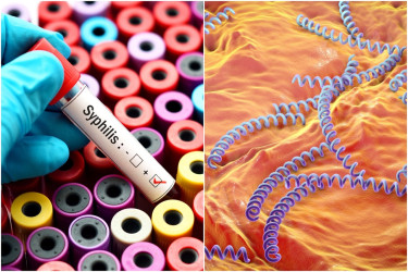 Ako sa prejavuje syfilis? Toto je hlavný príznak!