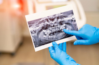 RTG zubov – kedy sa robí zubný röntgen, čo môže odhaliť a ako prebieha?