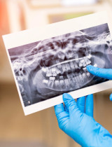 RTG zubov – kedy sa robí zubný röntgen, čo môže odhaliť a ako prebieha?