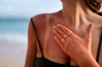 Ako sa nespáliť na slnku: Reálne tipy, ktoré fungujú lepšie než SPF 50