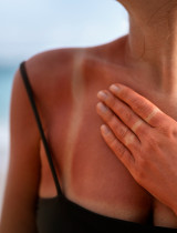 Ako sa nespáliť na slnku: Reálne tipy, ktoré fungujú lepšie než SPF 50