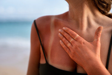 Ako sa nespáliť na slnku: Reálne tipy, ktoré fungujú lepšie než SPF 50