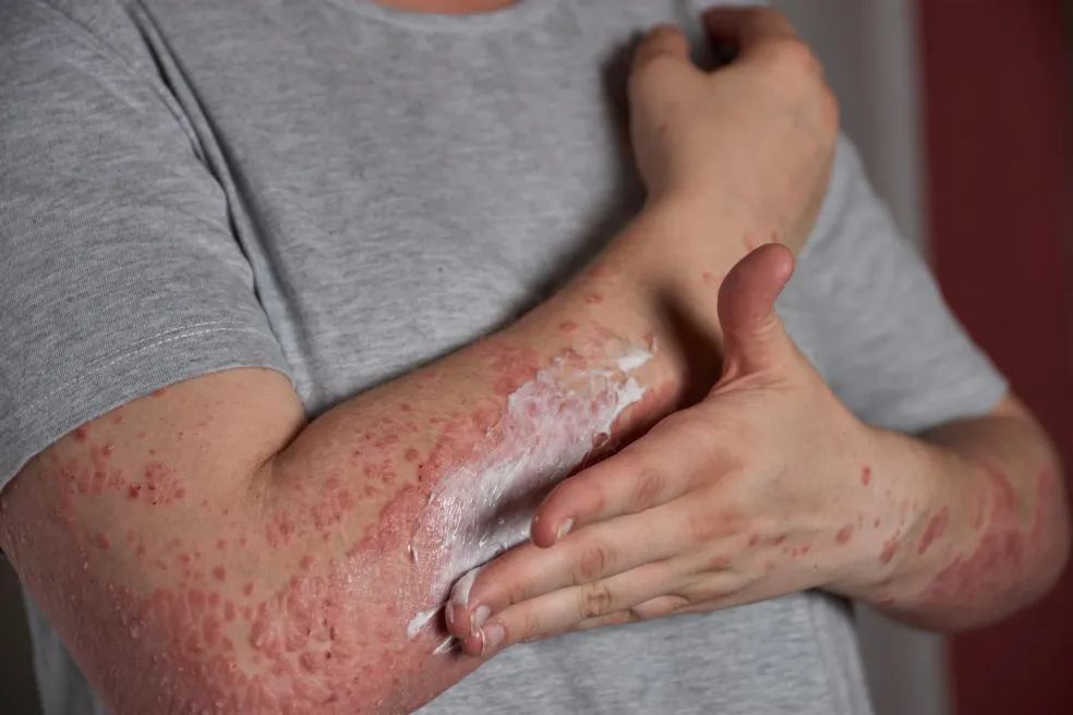 Nanášanie hydratačného krému na pokožku so psoriázou