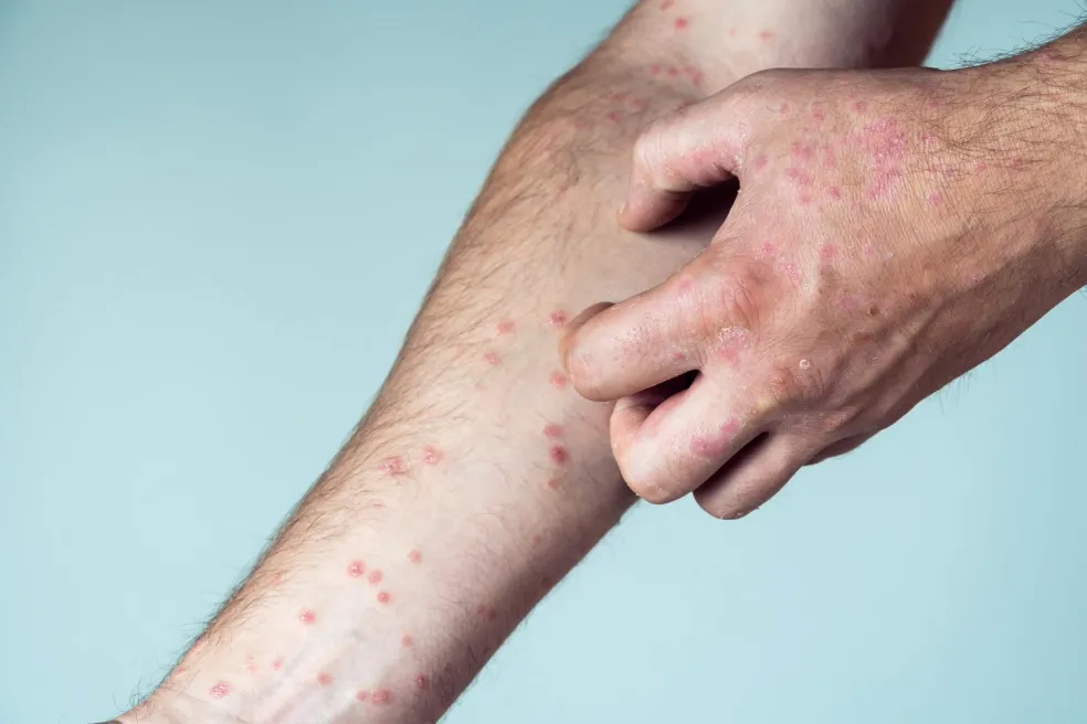 Červená zapálená pokožka na ruke zblízka