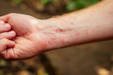Červené suché fľaky na tele: Ekzém, psoriáza alebo iná príčina?