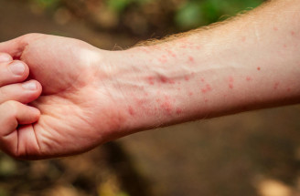 Červené suché fľaky na tele: Ekzém, psoriáza alebo iná príčina?